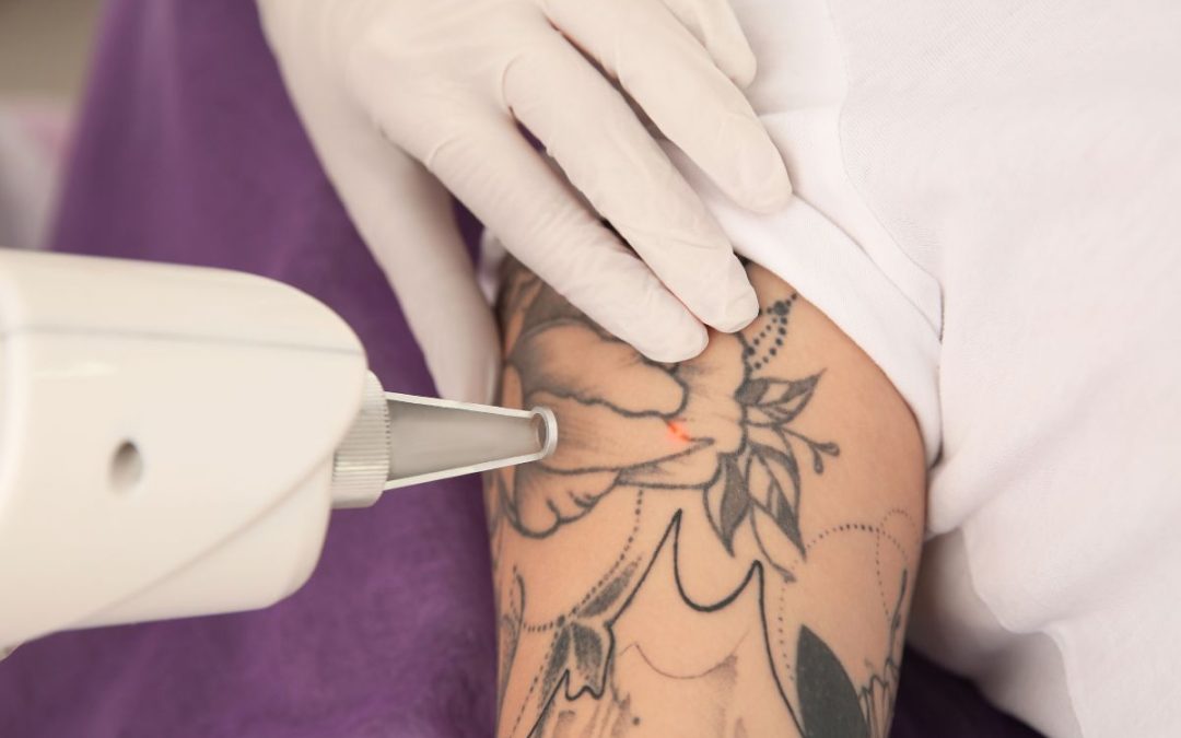 Rimozione Tatuaggio, le tecniche e cosa aspettarsi